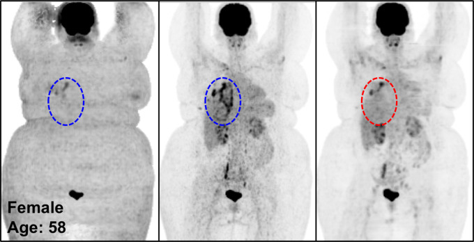 The potential pitfalls of PETDL are illustrated on noncorrected (left), attenuation- and scatter-corrected (middle), and deep learning–corrected (right) maximum intensity projection (MIP) PET images with (a) a missing one of two lesions in the chest (zoomed-in red box vs blue box), (b) an underestimated lesion in the spine, and (c, d) uncorrected pathologic structures in the chest (red vs blue dashed ellipse). A high-uptake lesion was missed in a and blurred in b, and the pathologic patterns were not corrected accurately on the PETDL images in b and c.