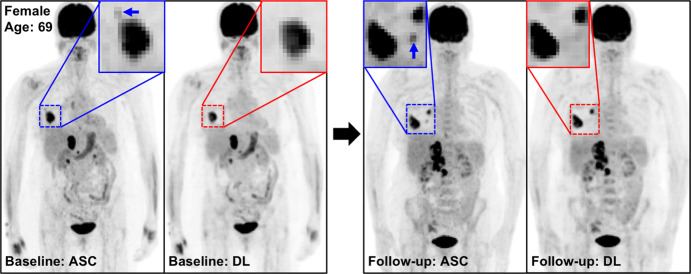 The potential benefits of PETDL are illustrated on baseline and 2-month follow-up PETASC and PETDL maximum intensity projection (MIP) scans in (a, b) patients with cancer and (c, d) adolescents who are at higher risk for radiation-induced damage. Note the overestimated tumor and streak artifacts on the DL-corrected images in a and the small blurred out low-uptake lesion on the DL-corrected images in b. Rotating MIP animations of PETASC and PETDL are shown in Figure E2 (supplement). Blue arrows indicate FDG findings with very low uptake that are not seen in PETDL.