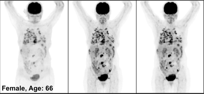 PETNC (left), PETASC (middle), and PETDL (right) maximum intensity projection (MIP) images in (a) a healthy patient, (b) a patient with widely metastatic cancer, (c) a patient with sparsely metastatic cancer, and (d) an obese patient demonstrate the overall quality of PETDL images. Rotating MIP animations of PETASC and PETDL are shown in Figure E1 (supplement).