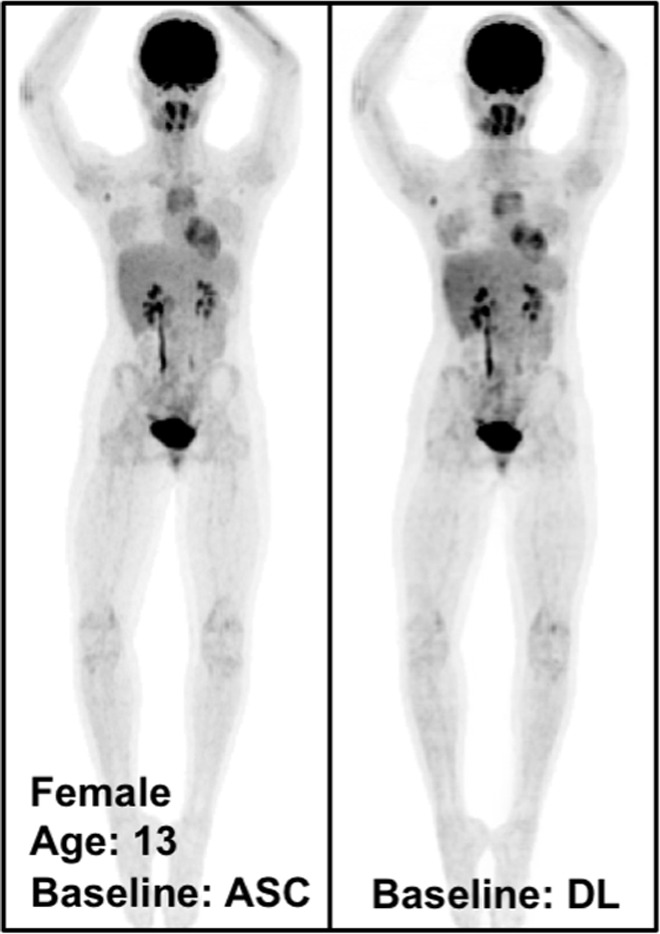 The potential benefits of PETDL are illustrated on baseline and 2-month follow-up PETASC and PETDL maximum intensity projection (MIP) scans in (a, b) patients with cancer and (c, d) adolescents who are at higher risk for radiation-induced damage. Note the overestimated tumor and streak artifacts on the DL-corrected images in a and the small blurred out low-uptake lesion on the DL-corrected images in b. Rotating MIP animations of PETASC and PETDL are shown in Figure E2 (supplement). Blue arrows indicate FDG findings with very low uptake that are not seen in PETDL.