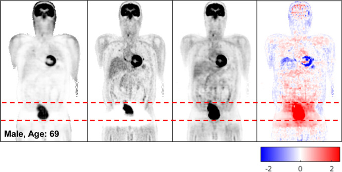 Coronal PETNC (far left column), PETASC (second from left column), PETDL (third from left column), and PETDL − PETASC (far right column) images illustrate the potential benefits of PETDL in (a) a patient with attenuation artifacts at the liver dome (blue arrows) and (b) a patient with washout artifacts near the bladder, who was excluded from the training set because of significant photopenic artifact. The pixel units on the difference images (far right) are standardized uptake values. Red dashed lines indicate range of the bladder. Blue and red coloration indicate under- and overestimated voxels in PETDL compared to the reference PETASC.