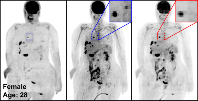 The potential pitfalls of PETDL are illustrated on noncorrected (left), attenuation- and scatter-corrected (middle), and deep learning–corrected (right) maximum intensity projection (MIP) PET images with (a) a missing one of two lesions in the chest (zoomed-in red box vs blue box), (b) an underestimated lesion in the spine, and (c, d) uncorrected pathologic structures in the chest (red vs blue dashed ellipse). A high-uptake lesion was missed in a and blurred in b, and the pathologic patterns were not corrected accurately on the PETDL images in b and c.