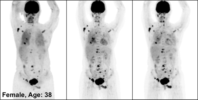 PETNC (left), PETASC (middle), and PETDL (right) maximum intensity projection (MIP) images in (a) a healthy patient, (b) a patient with widely metastatic cancer, (c) a patient with sparsely metastatic cancer, and (d) an obese patient demonstrate the overall quality of PETDL images. Rotating MIP animations of PETASC and PETDL are shown in Figure E1 (supplement).