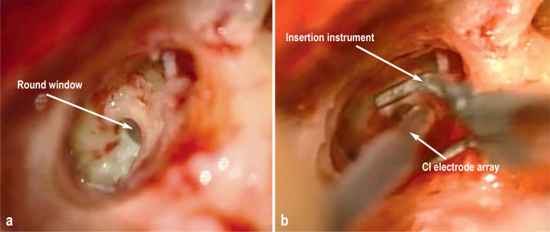 Figure 2: Insertion of the cochlear implant (CI) electrodes