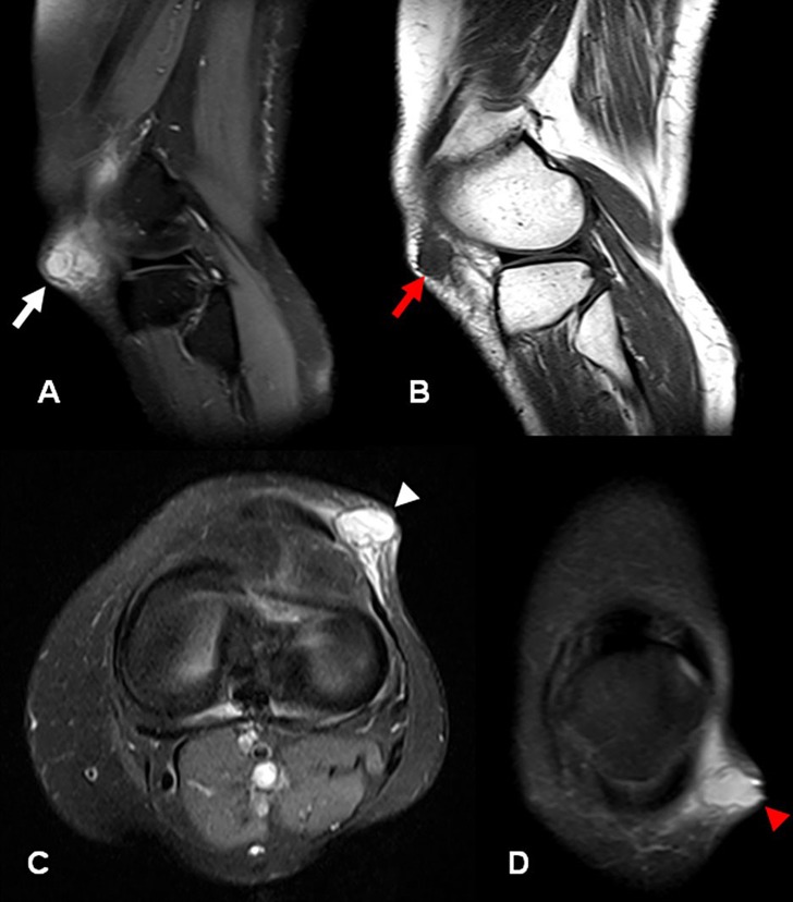 Ganglion cysts in the lateral portal region of the knee after ...