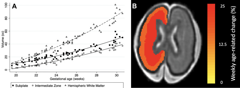 Subanalysis of the fetal hemispheric white matter transient zones in fetuses younger than 31 weeks of gestational age. (A) Plot shows volumetric age-related change for the fetal white matter transient zones (subplate and intermediate zone). (B) Heat map depicts weekly age-related change of the subplate (25.2%) and the intermediate zone (15.7%) overlaid in a 25-week-old female fetus.