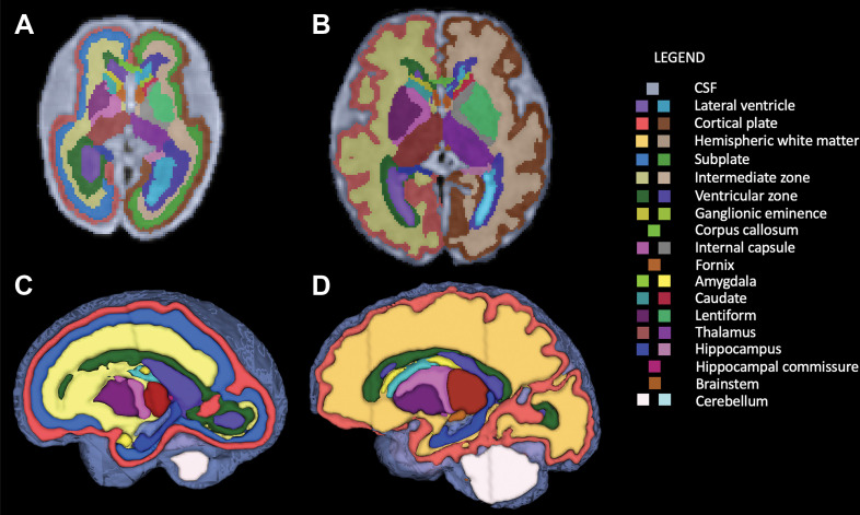 Segmentation of fetal brain structures. Twenty-eight individual structures were segmented and refined for all fetuses, and for fetuses less than 31 weeks of gestational age, the fetal white matter transient zones were additionally segmented. Image shows two-dimensional axial fetal segmentations for (A) a 25-week-old fetus and (B) a 36-week-old fetus, as well as (C, D) the three-dimensional volumetric segmentations (C corresponds with A, and D with B). A color bar is shown with labels for all structures.