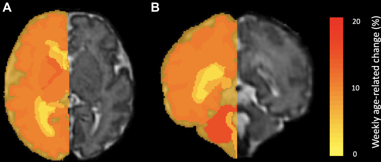 Heat maps show volumetric age-related change. Weekly age-related percentage change is overlaid in a 35-week-old male fetus. (A) Axial and (B) coronal heat maps show region-specific changes, which range from 2% (yellow) to 19% (red) for all evaluated structures.