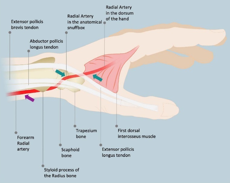 Figure 3 (32 ). Repère anatomique de l’accès radial.