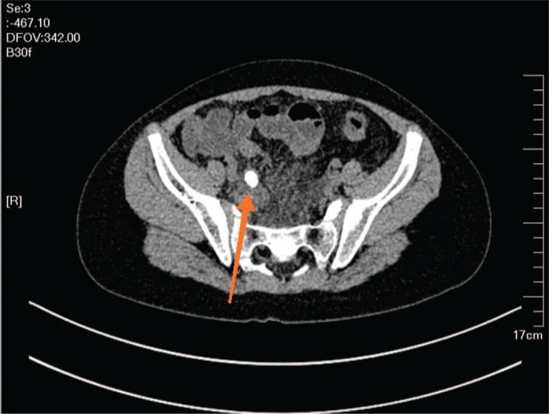 Diagnostic Accuracy Of Pediatric Atypical Appendicitis: Three Case 