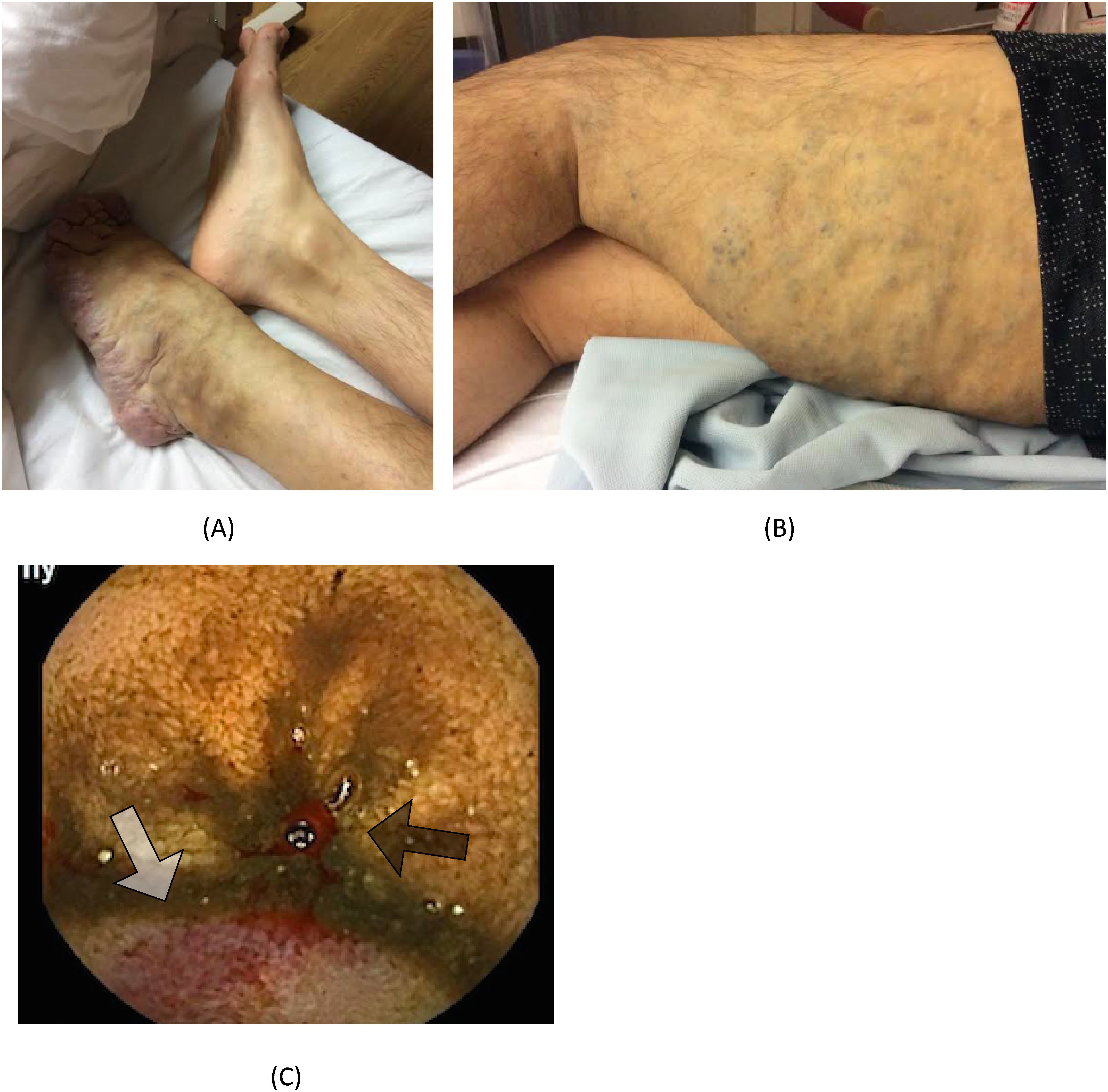 Fig. 1 Elastic, black-toned angiomatous lesions of 0.5–2 cm in areas (A) surrounding the joint in the left foot and (B) from the left buttock to the dorsal thigh. (C) Capsule endoscopy shows oozing bleeding (black arrow) and dilated vein (white arrow) at ileum. Informed consent was obtained from the patient for publication of the photographic materials.