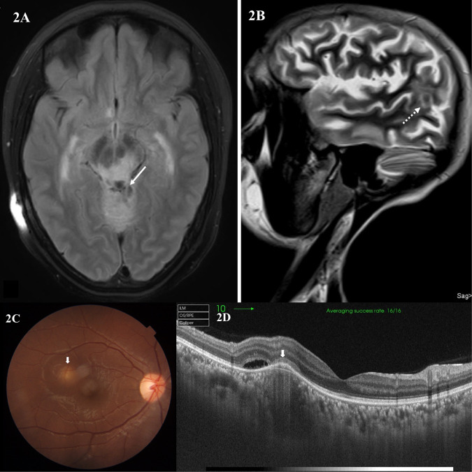 Neuro-ophthalmic manifestations of tuberculosis - PMC