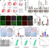 Figure 5. TIME induced by elevated St8sia4 in mice and patients with breast cancer. A and B, The immune cell population analysis by CyTOF technology with antibodies of CD45+/CD11b+/Ly6G+/Ly6C− for PMN-MDSC, CD45+/CD11b+/Ly6G−/Ly6C+ for M-MDSC, CD45+/CD3+/CD4+/CD8− for CD4 T cells, CD45+/CD3+/CD4−/CD8+ for CD8 T cells (A), and quantification of the immune cell populations (B) in mammary tissues from control mammary gland (MG), mammary tumor tissues from 14 days after implantation of EMT6 cells, EMT6-OE-St8sia4 cells, EMT6-OE-St8sia4/sgSt8sia4 cells, 26 days after implantation of EMT6 cells, EMT6-OE-St8sia4 cells, EMT6-OE-St8sia4/sgSt8sia4 cells in Balb/c mice (n = 3–5 mice/group). C–E, Representative images of macrophages in breast tumor tissues from Balb/c mice with fat pad implantation of EMT6 and EMT6-OE-St8sia4 cells by staining with F4/80/CD86 for M1-like (C), F4/80/CD206 for M2-like (D), and the quantified macrophage number (n = 30 pictures from 5 mice/group; E). Scale bar, 10 μm. F and G, Representative images of MDSC in breast tumor (BT) from nude mice with fat pad implantation of B477, G600, G600-sgVegfa, and G600-sgIl6 cells by staining with S100a9 (F) and quantified S100A9-positive MDSC (n = 18 pictures from 6 mice/group; G). Scale bar, 50 μm. H and I, Representative images of MDSC in the spleen (H) from nude mice with fat pad implantation of 545, 545-OE-St8sia4, 628W, and 628W-sgSt8sia4 cells (C) by staining with S100a9 and quantified S100A9-positive MDSC (n = 18 pictures from 6 mice/group; I). Scale bar, 50 μm. J, Western blot showing protein level of TGFβ signaling in spleen and bone marrow from Brca1-WT and Brca1MKO mice. K–M, Correlations between the expression of St8sia4 immune cell populations of MDSC (K), macrophage (L), and Treg (M) in breast cancer patients from TISIDB. N, Breast cancer patients' survival outcomes with different levels of St8sia4 expression and CD8+ T-cell infiltration. Data are presented as means ± SD and P values were determined by one-way ANOVA (B, G, and I) and an unpaired Student t test (E). *, P < 0.05; **, P < 0.01; ***, P < 0.001; ****, P < 0.0001.