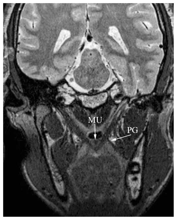 Morphology of the Levator Veli Palatini Muscle Using Magnetic Resonance ...