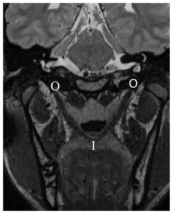 Morphology of the Levator Veli Palatini Muscle Using Magnetic Resonance ...