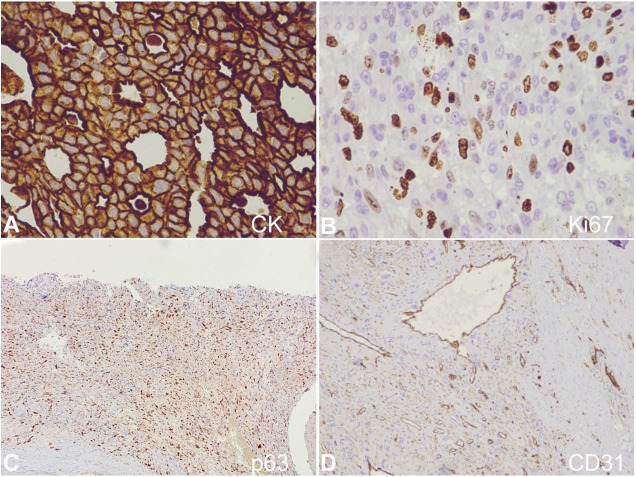 Metaplastic breast carcinoma with extensive osseous differentiation - PMC