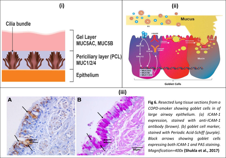 Cytokine Storm and Mucus Hypersecretion in COVID-19: Review of ...