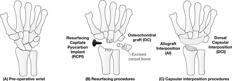 Proximal Row Carpectomy Modifications for Capitate Arthritis: A ...