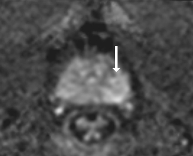 Images show representative peripheral zone lesions (arrow). (a) Prostate Imaging Reporting and Data System (PI-RADS) score 2. T2-weighted MRI scan shows triangular lesion with low T2 signal intensity in right midgland. (b–d) PI-RADS score 3. T2-weighted MRI scan (b), diffusion-weighted MRI scan obtained with high b value (c), and apparent diffusion coefficient (ADC) map (d) show focal lesion in left apex. Lesion has mildly low signal intensity on ADC map and mildly high signal intensity on diffusion-weighted image. No enhancement was seen on dynamic contrast material–enhanced image (not shown). (e–g) PI-RADS score 4. T2-weighted MRI scan (e), diffusion-weighted MRI scan obtained with high b value (f), and ADC map (g) show 1.0-cm focal lesion in right midgland. Lesion has markedly low signal intensity on ADC map and markedly high signal intensity on diffusion-weighted MRI scan. (h) PI-RADS score 5. T2-weighted MRI scan shows large left midgland lesion associated with extraprostatic extension.