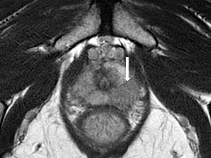 Images show representative peripheral zone lesions (arrow). (a) Prostate Imaging Reporting and Data System (PI-RADS) score 2. T2-weighted MRI scan shows triangular lesion with low T2 signal intensity in right midgland. (b–d) PI-RADS score 3. T2-weighted MRI scan (b), diffusion-weighted MRI scan obtained with high b value (c), and apparent diffusion coefficient (ADC) map (d) show focal lesion in left apex. Lesion has mildly low signal intensity on ADC map and mildly high signal intensity on diffusion-weighted image. No enhancement was seen on dynamic contrast material–enhanced image (not shown). (e–g) PI-RADS score 4. T2-weighted MRI scan (e), diffusion-weighted MRI scan obtained with high b value (f), and ADC map (g) show 1.0-cm focal lesion in right midgland. Lesion has markedly low signal intensity on ADC map and markedly high signal intensity on diffusion-weighted MRI scan. (h) PI-RADS score 5. T2-weighted MRI scan shows large left midgland lesion associated with extraprostatic extension.