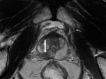 Images show representative peripheral zone lesions (arrow). (a) Prostate Imaging Reporting and Data System (PI-RADS) score 2. T2-weighted MRI scan shows triangular lesion with low T2 signal intensity in right midgland. (b–d) PI-RADS score 3. T2-weighted MRI scan (b), diffusion-weighted MRI scan obtained with high b value (c), and apparent diffusion coefficient (ADC) map (d) show focal lesion in left apex. Lesion has mildly low signal intensity on ADC map and mildly high signal intensity on diffusion-weighted image. No enhancement was seen on dynamic contrast material–enhanced image (not shown). (e–g) PI-RADS score 4. T2-weighted MRI scan (e), diffusion-weighted MRI scan obtained with high b value (f), and ADC map (g) show 1.0-cm focal lesion in right midgland. Lesion has markedly low signal intensity on ADC map and markedly high signal intensity on diffusion-weighted MRI scan. (h) PI-RADS score 5. T2-weighted MRI scan shows large left midgland lesion associated with extraprostatic extension.