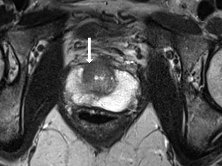 T2-weighted MRI scans show representative transition zone lesions (arrow). (a) Prostate Imaging Reporting and Data System (PI-RADS) score 2. Image shows encapsulated, mildly heterogeneous nodule in left midgland to base with predominantly low signal intensity. (b) PI-RADS score 3. Image shows heterogeneous signal intensity with ill-defined margins in right midgland. (c) PI-RADS score 4. Image shows small, noncircumscribed lesion with homogeneous and moderately low signal intensity at right apex to midgland level. (d) PI-RADS score 5. Image shows bilateral midgland, large lenticular lesion in midgland with homogeneous and moderately low signal intensity that extends into the anterior fibromuscular stroma.