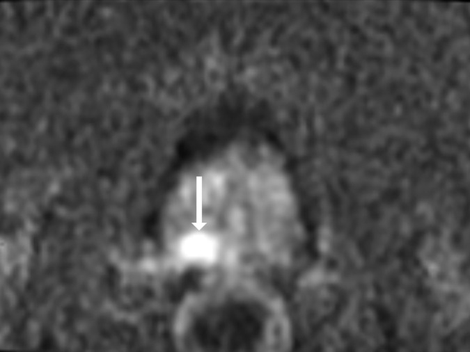 Images show representative peripheral zone lesions (arrow). (a) Prostate Imaging Reporting and Data System (PI-RADS) score 2. T2-weighted MRI scan shows triangular lesion with low T2 signal intensity in right midgland. (b–d) PI-RADS score 3. T2-weighted MRI scan (b), diffusion-weighted MRI scan obtained with high b value (c), and apparent diffusion coefficient (ADC) map (d) show focal lesion in left apex. Lesion has mildly low signal intensity on ADC map and mildly high signal intensity on diffusion-weighted image. No enhancement was seen on dynamic contrast material–enhanced image (not shown). (e–g) PI-RADS score 4. T2-weighted MRI scan (e), diffusion-weighted MRI scan obtained with high b value (f), and ADC map (g) show 1.0-cm focal lesion in right midgland. Lesion has markedly low signal intensity on ADC map and markedly high signal intensity on diffusion-weighted MRI scan. (h) PI-RADS score 5. T2-weighted MRI scan shows large left midgland lesion associated with extraprostatic extension.