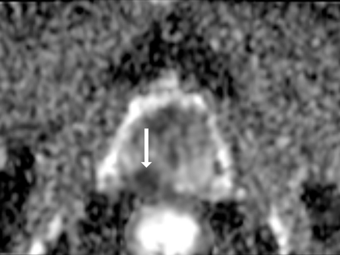 Images show representative peripheral zone lesions (arrow). (a) Prostate Imaging Reporting and Data System (PI-RADS) score 2. T2-weighted MRI scan shows triangular lesion with low T2 signal intensity in right midgland. (b–d) PI-RADS score 3. T2-weighted MRI scan (b), diffusion-weighted MRI scan obtained with high b value (c), and apparent diffusion coefficient (ADC) map (d) show focal lesion in left apex. Lesion has mildly low signal intensity on ADC map and mildly high signal intensity on diffusion-weighted image. No enhancement was seen on dynamic contrast material–enhanced image (not shown). (e–g) PI-RADS score 4. T2-weighted MRI scan (e), diffusion-weighted MRI scan obtained with high b value (f), and ADC map (g) show 1.0-cm focal lesion in right midgland. Lesion has markedly low signal intensity on ADC map and markedly high signal intensity on diffusion-weighted MRI scan. (h) PI-RADS score 5. T2-weighted MRI scan shows large left midgland lesion associated with extraprostatic extension.