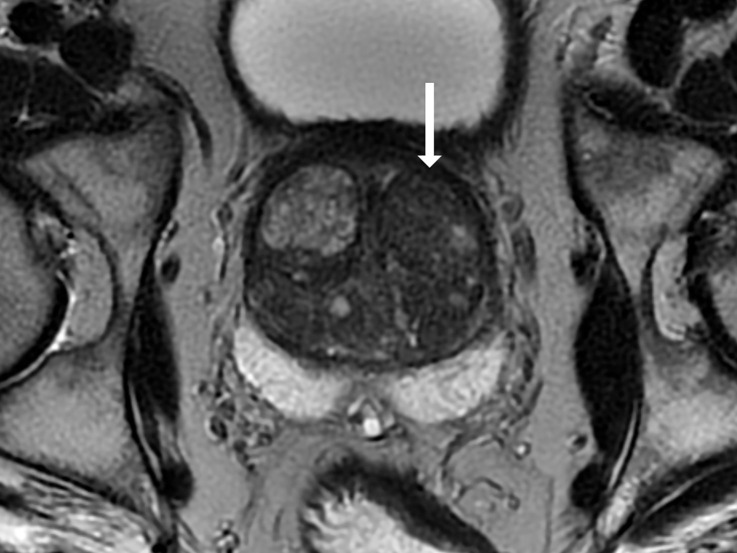 T2-weighted MRI scans show representative transition zone lesions (arrow). (a) Prostate Imaging Reporting and Data System (PI-RADS) score 2. Image shows encapsulated, mildly heterogeneous nodule in left midgland to base with predominantly low signal intensity. (b) PI-RADS score 3. Image shows heterogeneous signal intensity with ill-defined margins in right midgland. (c) PI-RADS score 4. Image shows small, noncircumscribed lesion with homogeneous and moderately low signal intensity at right apex to midgland level. (d) PI-RADS score 5. Image shows bilateral midgland, large lenticular lesion in midgland with homogeneous and moderately low signal intensity that extends into the anterior fibromuscular stroma.