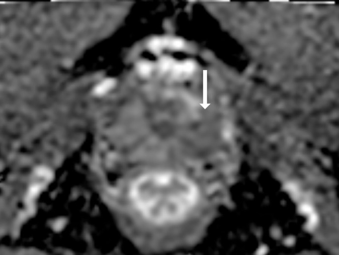 Images show representative peripheral zone lesions (arrow). (a) Prostate Imaging Reporting and Data System (PI-RADS) score 2. T2-weighted MRI scan shows triangular lesion with low T2 signal intensity in right midgland. (b–d) PI-RADS score 3. T2-weighted MRI scan (b), diffusion-weighted MRI scan obtained with high b value (c), and apparent diffusion coefficient (ADC) map (d) show focal lesion in left apex. Lesion has mildly low signal intensity on ADC map and mildly high signal intensity on diffusion-weighted image. No enhancement was seen on dynamic contrast material–enhanced image (not shown). (e–g) PI-RADS score 4. T2-weighted MRI scan (e), diffusion-weighted MRI scan obtained with high b value (f), and ADC map (g) show 1.0-cm focal lesion in right midgland. Lesion has markedly low signal intensity on ADC map and markedly high signal intensity on diffusion-weighted MRI scan. (h) PI-RADS score 5. T2-weighted MRI scan shows large left midgland lesion associated with extraprostatic extension.