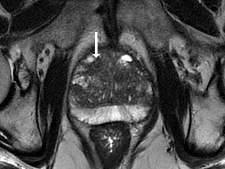 T2-weighted MRI scans show representative transition zone lesions (arrow). (a) Prostate Imaging Reporting and Data System (PI-RADS) score 2. Image shows encapsulated, mildly heterogeneous nodule in left midgland to base with predominantly low signal intensity. (b) PI-RADS score 3. Image shows heterogeneous signal intensity with ill-defined margins in right midgland. (c) PI-RADS score 4. Image shows small, noncircumscribed lesion with homogeneous and moderately low signal intensity at right apex to midgland level. (d) PI-RADS score 5. Image shows bilateral midgland, large lenticular lesion in midgland with homogeneous and moderately low signal intensity that extends into the anterior fibromuscular stroma.