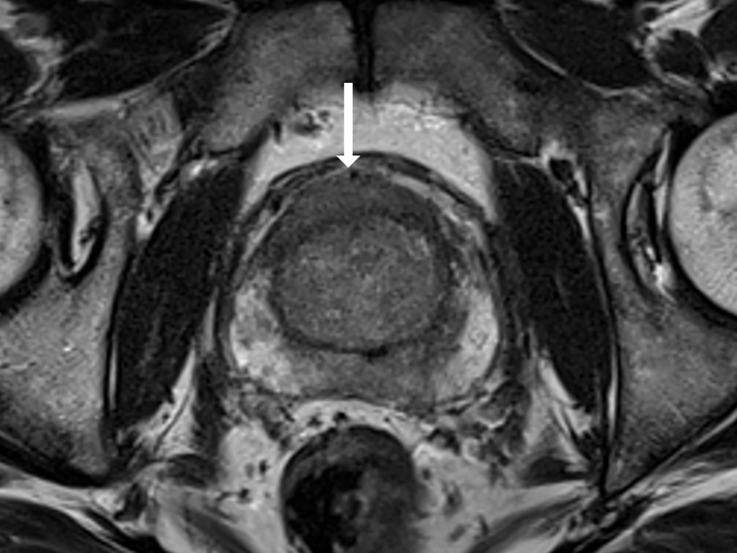 T2-weighted MRI scans show representative transition zone lesions (arrow). (a) Prostate Imaging Reporting and Data System (PI-RADS) score 2. Image shows encapsulated, mildly heterogeneous nodule in left midgland to base with predominantly low signal intensity. (b) PI-RADS score 3. Image shows heterogeneous signal intensity with ill-defined margins in right midgland. (c) PI-RADS score 4. Image shows small, noncircumscribed lesion with homogeneous and moderately low signal intensity at right apex to midgland level. (d) PI-RADS score 5. Image shows bilateral midgland, large lenticular lesion in midgland with homogeneous and moderately low signal intensity that extends into the anterior fibromuscular stroma.