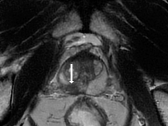 Images show representative peripheral zone lesions (arrow). (a) Prostate Imaging Reporting and Data System (PI-RADS) score 2. T2-weighted MRI scan shows triangular lesion with low T2 signal intensity in right midgland. (b–d) PI-RADS score 3. T2-weighted MRI scan (b), diffusion-weighted MRI scan obtained with high b value (c), and apparent diffusion coefficient (ADC) map (d) show focal lesion in left apex. Lesion has mildly low signal intensity on ADC map and mildly high signal intensity on diffusion-weighted image. No enhancement was seen on dynamic contrast material–enhanced image (not shown). (e–g) PI-RADS score 4. T2-weighted MRI scan (e), diffusion-weighted MRI scan obtained with high b value (f), and ADC map (g) show 1.0-cm focal lesion in right midgland. Lesion has markedly low signal intensity on ADC map and markedly high signal intensity on diffusion-weighted MRI scan. (h) PI-RADS score 5. T2-weighted MRI scan shows large left midgland lesion associated with extraprostatic extension.