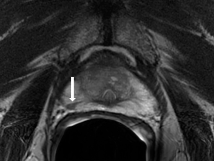 Images show representative peripheral zone lesions (arrow). (a) Prostate Imaging Reporting and Data System (PI-RADS) score 2. T2-weighted MRI scan shows triangular lesion with low T2 signal intensity in right midgland. (b–d) PI-RADS score 3. T2-weighted MRI scan (b), diffusion-weighted MRI scan obtained with high b value (c), and apparent diffusion coefficient (ADC) map (d) show focal lesion in left apex. Lesion has mildly low signal intensity on ADC map and mildly high signal intensity on diffusion-weighted image. No enhancement was seen on dynamic contrast material–enhanced image (not shown). (e–g) PI-RADS score 4. T2-weighted MRI scan (e), diffusion-weighted MRI scan obtained with high b value (f), and ADC map (g) show 1.0-cm focal lesion in right midgland. Lesion has markedly low signal intensity on ADC map and markedly high signal intensity on diffusion-weighted MRI scan. (h) PI-RADS score 5. T2-weighted MRI scan shows large left midgland lesion associated with extraprostatic extension.