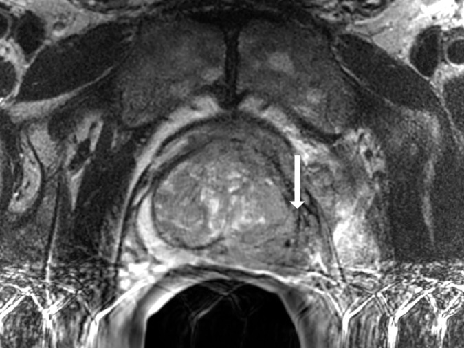 Images show representative peripheral zone lesions (arrow). (a) Prostate Imaging Reporting and Data System (PI-RADS) score 2. T2-weighted MRI scan shows triangular lesion with low T2 signal intensity in right midgland. (b–d) PI-RADS score 3. T2-weighted MRI scan (b), diffusion-weighted MRI scan obtained with high b value (c), and apparent diffusion coefficient (ADC) map (d) show focal lesion in left apex. Lesion has mildly low signal intensity on ADC map and mildly high signal intensity on diffusion-weighted image. No enhancement was seen on dynamic contrast material–enhanced image (not shown). (e–g) PI-RADS score 4. T2-weighted MRI scan (e), diffusion-weighted MRI scan obtained with high b value (f), and ADC map (g) show 1.0-cm focal lesion in right midgland. Lesion has markedly low signal intensity on ADC map and markedly high signal intensity on diffusion-weighted MRI scan. (h) PI-RADS score 5. T2-weighted MRI scan shows large left midgland lesion associated with extraprostatic extension.