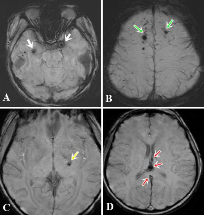 Diffuse axonal injury: a case report and MRI findings - PMC