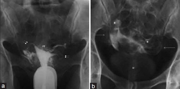 Venous Intravasation as a Complication and Potential Pitfall During ...