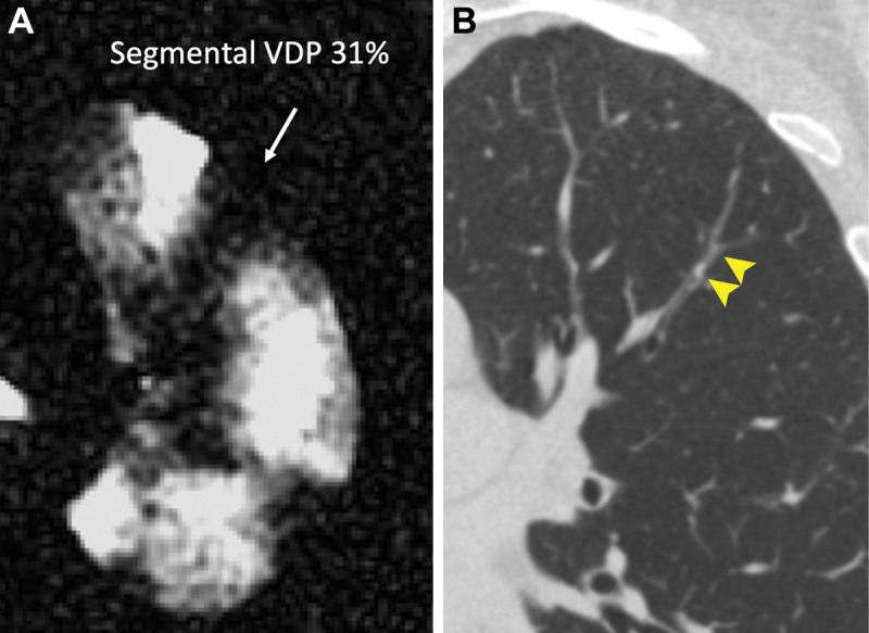 Representative images of (A) segmental ventilation defect percentage (VDP) affecting 31% of the segmental lobe volume at hyperpolarized helium 3 MRI (arrow) and (B) a spatially overlapping mucus plug visualized at CT (arrowheads).