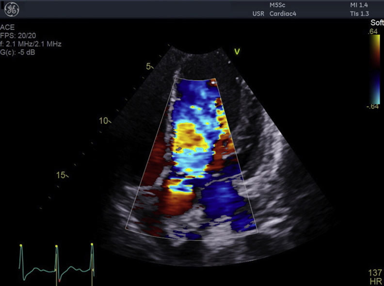 Acute And Chronic Complications Of Rheumatic Heart Disease PMC acute-and-chronic-complications-of-rheumatic-heart-disease-pmc