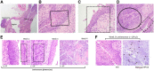 Figure 4. Anatomical orientation and lesion progression from HSIL to SCC in spontaneous HPV+ cervicovaginal carcinoma model. At each time point following the AMES-16-plasmid electroporation, Three mice were sacrificed and their reproductive tracts were harvested and fixed in formalin for sectioning and histologic analysis. Representative images of the histologic examination were selected. A, Magnification (×2) of mouse reproductive tract 3 weeks post AMES-16 DNA electroporation anatomically labeled. B, Magnification (×40) showing cervical HSIL in black box with orientation as shown by cervix in A. C, Magnification (×40) showing vaginal HSIL in dotted black box as shown in lower left corner of A. D, Magnification (×20) showing vaginal HSIL in dashed black box and carcinoma in black circle with orientation as shown in A. E, Development of SCC from HSIL. Left, emergence of HSIL (see box) corresponding with luminescence values approximately 1 × 106. Middle, appearance of SCC (see box) and corresponding with luminescence values approximately 1 × 107. Right, appearance of HSIL and invasive carcinoma corresponding with luminescence values approximately 1 × 108. F, Left, representative H&E of HSIL lesion 2 weeks post AMES-16 DNA electroporation. Right, HPV16 RNA (black arrows) colocalizes with HSIL lesion at week 2 post AMES-16 DNA electroporation with no evidence of HPV RNA expression in dermal compartment. HPV16 RNA was performed by RNAscope ISH.