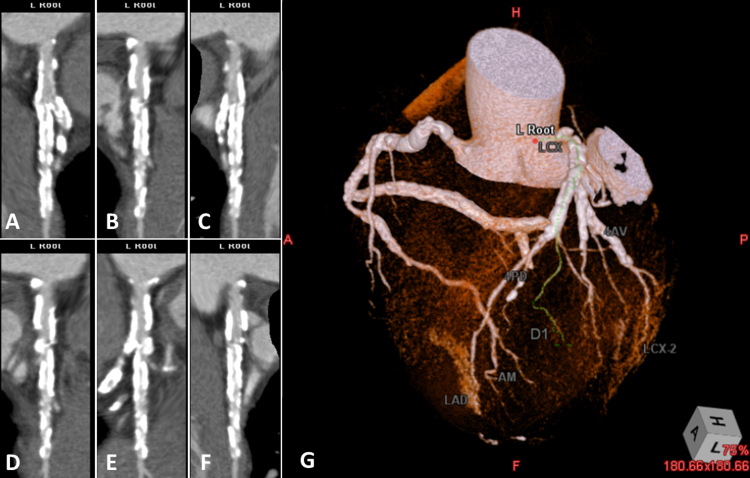 Ostial left circumflex lesion with calcified nodule successfully ...