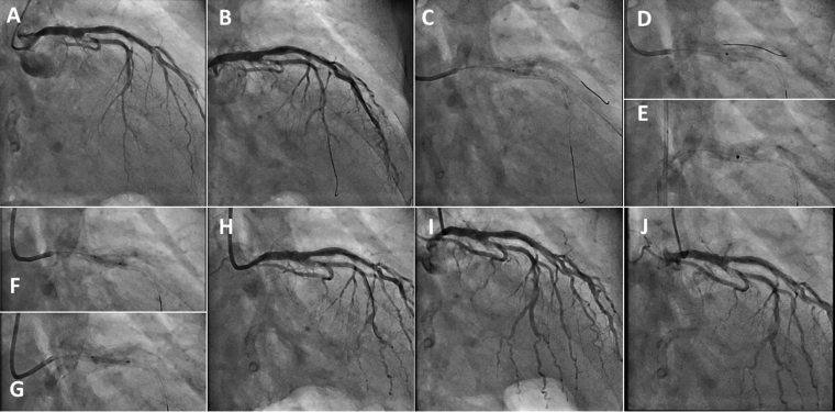 Ostial left circumflex lesion with calcified nodule successfully ...