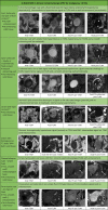 Image shows examples of Ovarian-Adnexal Reporting and Data System
(O-RADS) MRI 2 risk score. ^ = Unilocular cysts with simple or hemorrhagic
fluid 3 cm or smaller in a premenopausal woman would be classified as O-RADS
MRI 1. ^^ = Minimal enhancement of Rokitansky nodule in lesion containing
lipid does not change to O-RADS MRI 4. DWI = diffusion-weighted imaging, FS
= fat saturated, PPV = positive predictive value, T1WI = T1-weighted
imaging, T2WI = T2-weighted imaging.