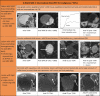Image shows examples of Ovarian-Adnexal Reporting and Data System
(O-RADS) MRI 4 risk score. DCE = dynamic contrast enhanced, DWI =
diffusion-weighted imaging, FS = fat saturated, PPV = positive predictive
value, TIC = time-intensity curve, T1WI = T1-weighted imaging, T2WI =
T2-weighted imaging.