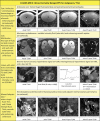 Image shows examples of Ovarian-Adnexal Reporting and Data System
(O-RADS) MRI 3 risk score. ^^ = Hemorrhagic cyst smaller than 3 cm in a
premenopausal woman would be classified as O-RADS MRI 2. DCE = dynamic
contrast enhanced, DWI = diffusion-weighted imaging, FS = fat saturated, PPV
= positive predictive value, TIC = time-intensity curve, T1WI = T1-weighted
imaging, T2WI = T2-weighted imaging.