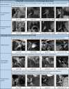 Image shows examples of Ovarian-Adnexal Reporting and Data System
(O-RADS) MRI 1 risk score. * = In postmenopausal women, normal
ovaries can contain very small residual follicles, and if the radiologist
subjectively assesses the ovaries as normal, the ovaries can be categorized
as O-RADS MRI 1. DWI = diffusion-weighted imaging, FS = fat saturated, T1WI
= T1-weighted imaging, T2WI = T2-weighted imaging.