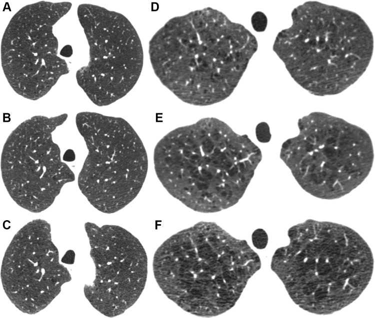 Axial CT sections at each follow-up visit show (A–C) nonprogression for a former smoker with trace emphysema and (D–F) progression for a current smoker with more than trace emphysema. (A–C) Images in a male former smoker who was 62 years old at baseline. (A) Baseline CT scan shows trace emphysema. CT scans obtained at (B) 5 and (C) 10 years show no significant change. (D–F) Images in a male current smoker who was 48 years old at baseline. (D) Baseline CT scan shows mild centrilobular emphysema. CT scans obtained at (E) 5 and (F) 10 years show increasing size and number of emphysematous spaces.