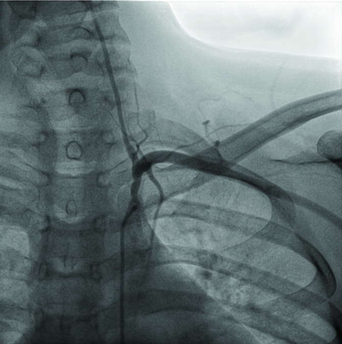 Takayasu Arteritis With Bilateral Renal Artery Stenosis And Left takayasu-arteritis-with-bilateral-renal-artery-stenosis-and-left