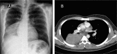 Figure 1A & B: