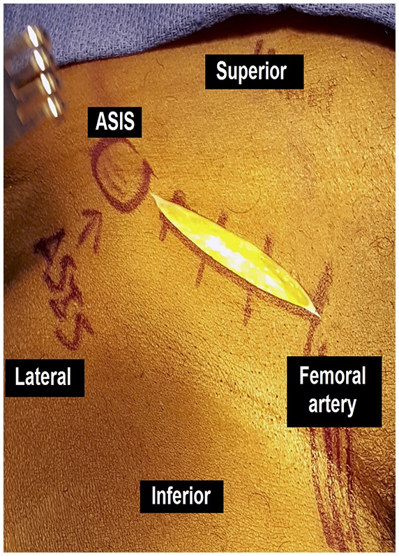 Treatment of Hip Flexion Contractures with Psoas Recession Through the ...